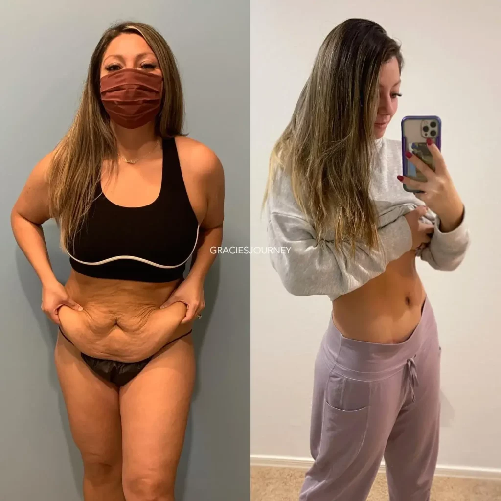 Tummy Tuck Before and After