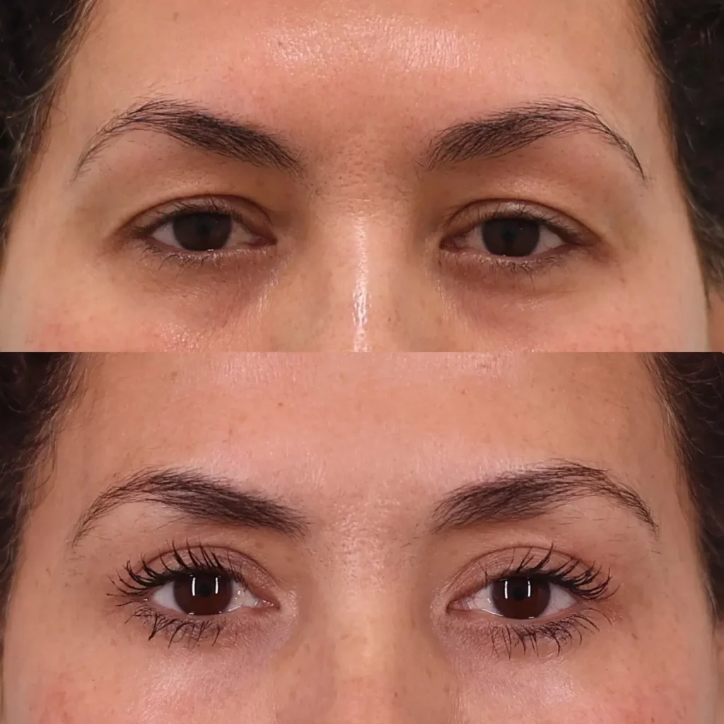 Blepharoplasty Before and After