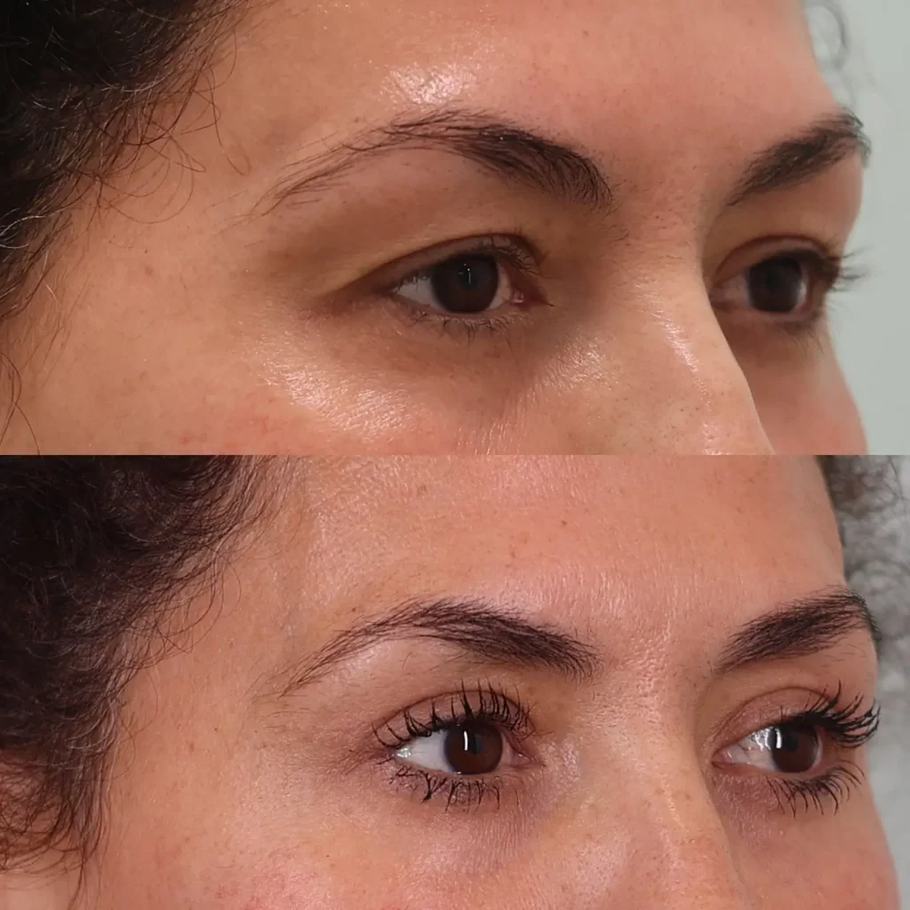 Blepharoplasty Before and After