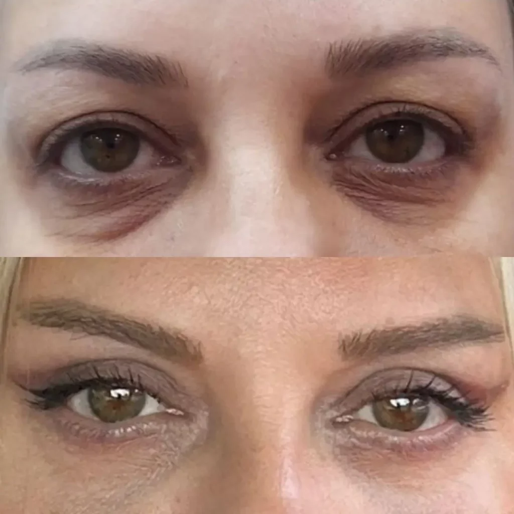 Blepharoplasty Before and After