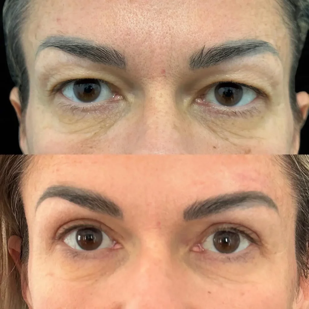 Blepharoplasty Before and After