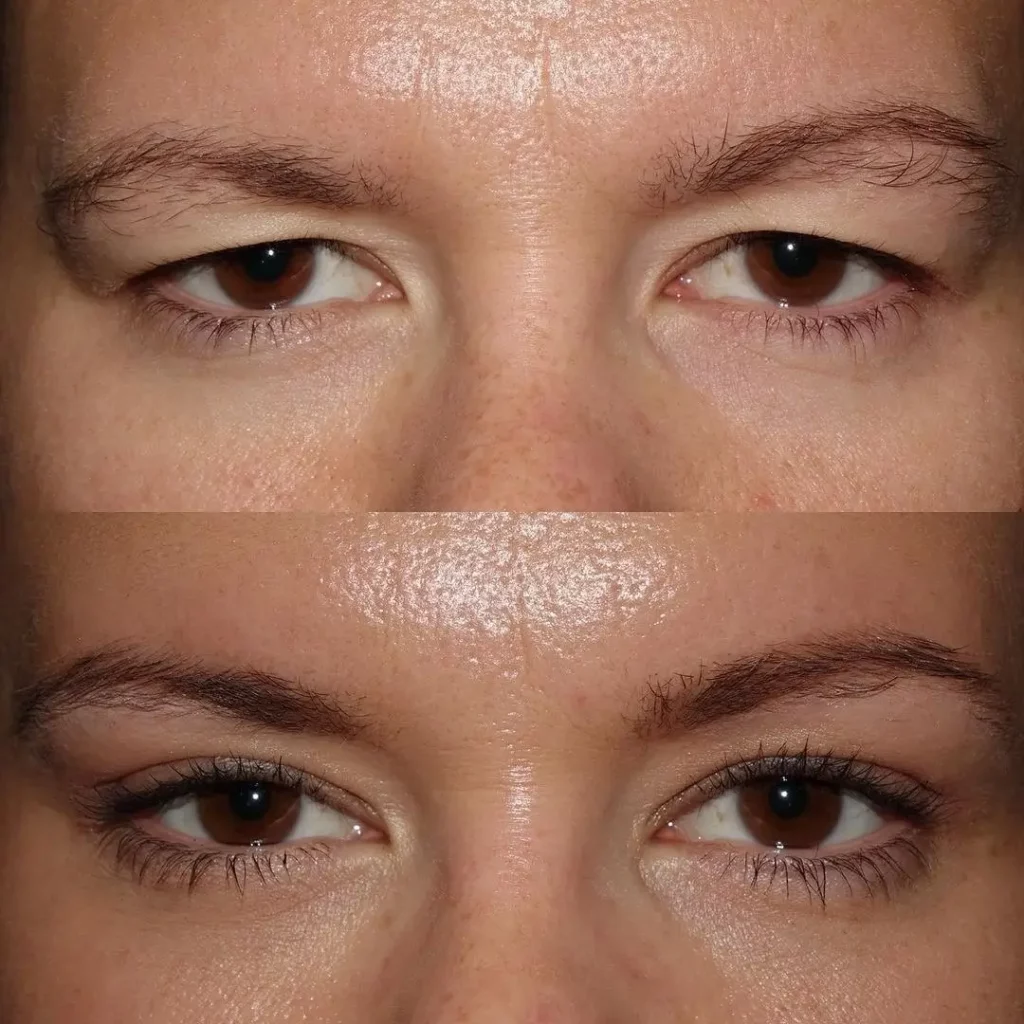 Blepharoplasty Before and After