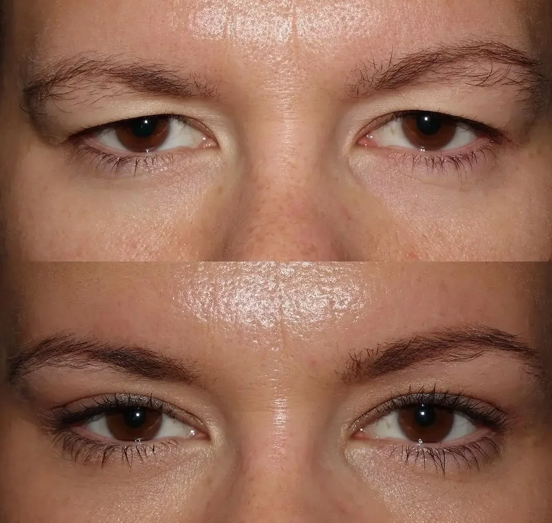 Blepharoplasty Before and After