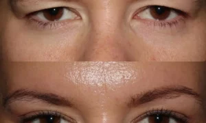 Blepharoplasty Before and After