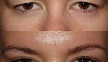 Blepharoplasty Before and After