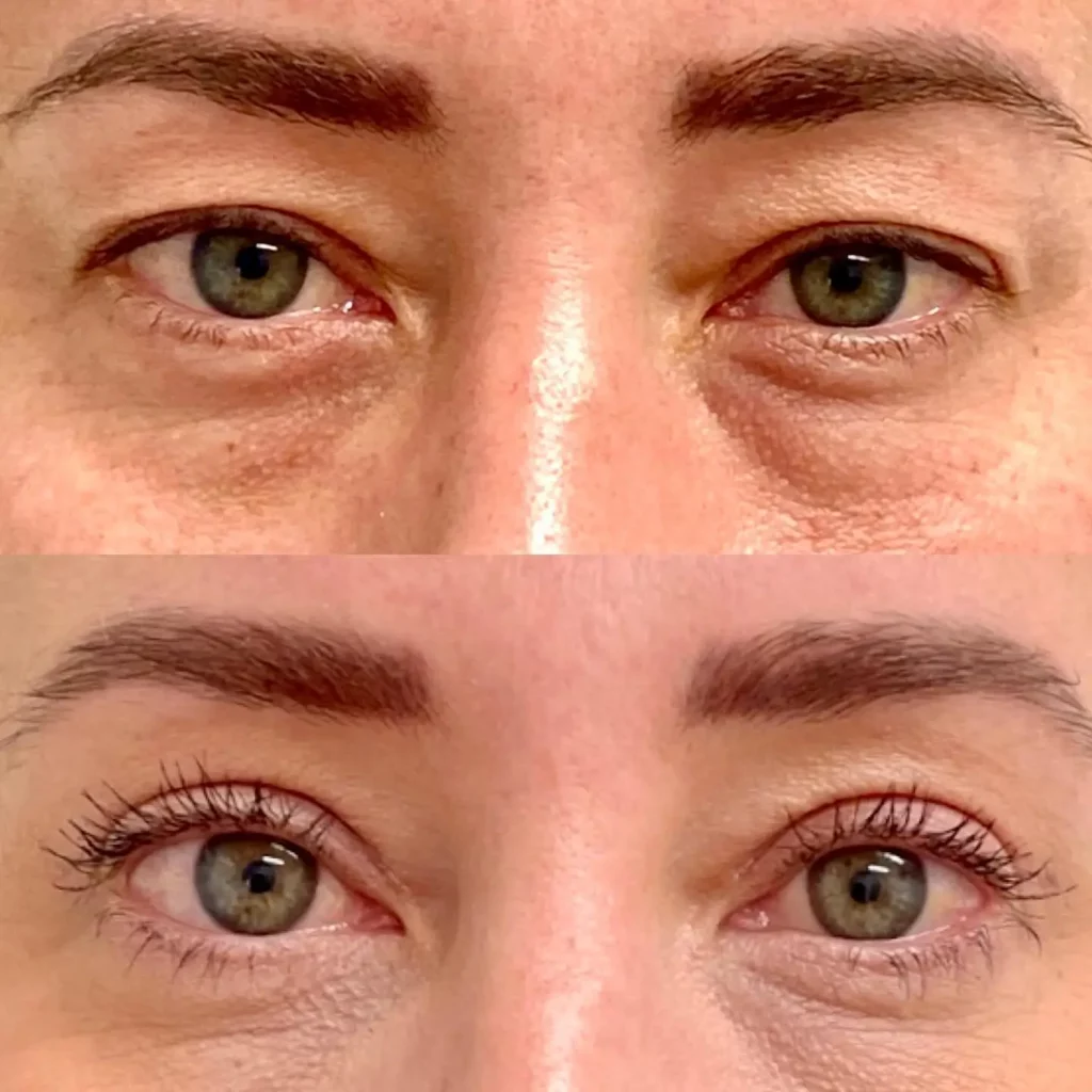 Blepharoplasty Before and After