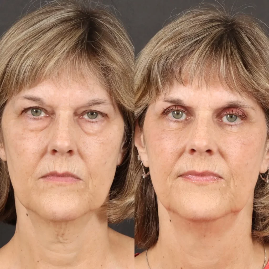 Blepharoplasty Before and After