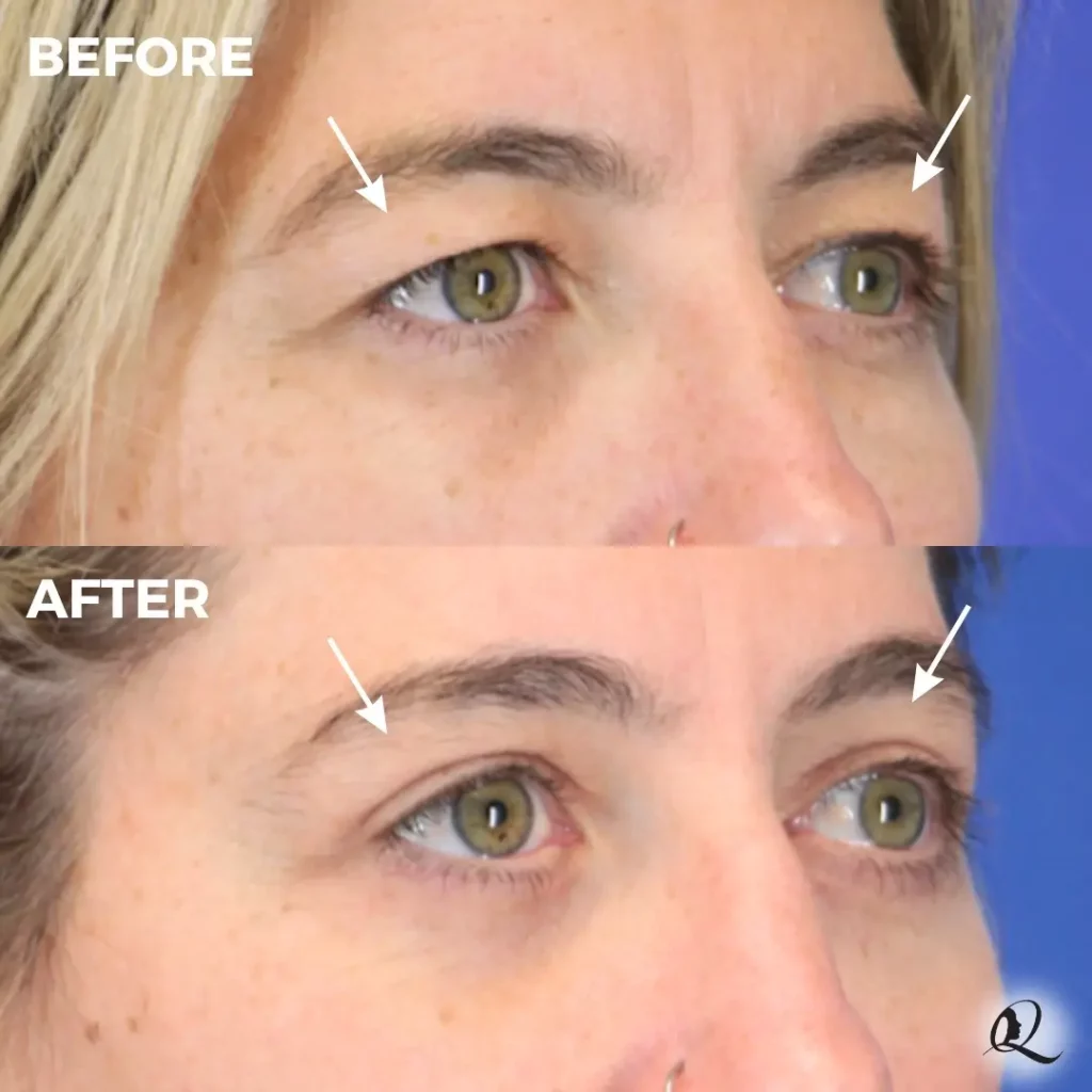 Blepharoplasty Before and After