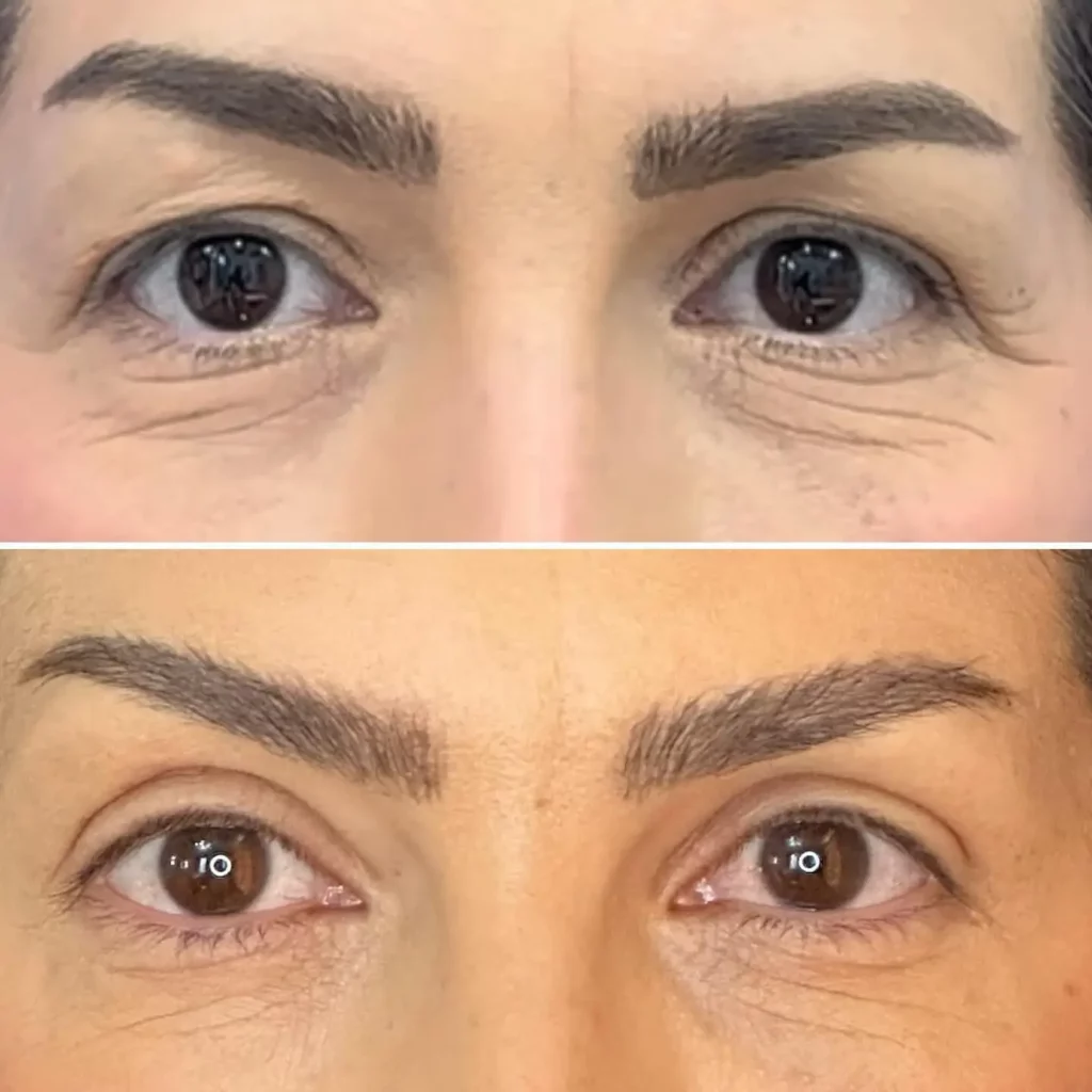 Blepharoplasty Before and After