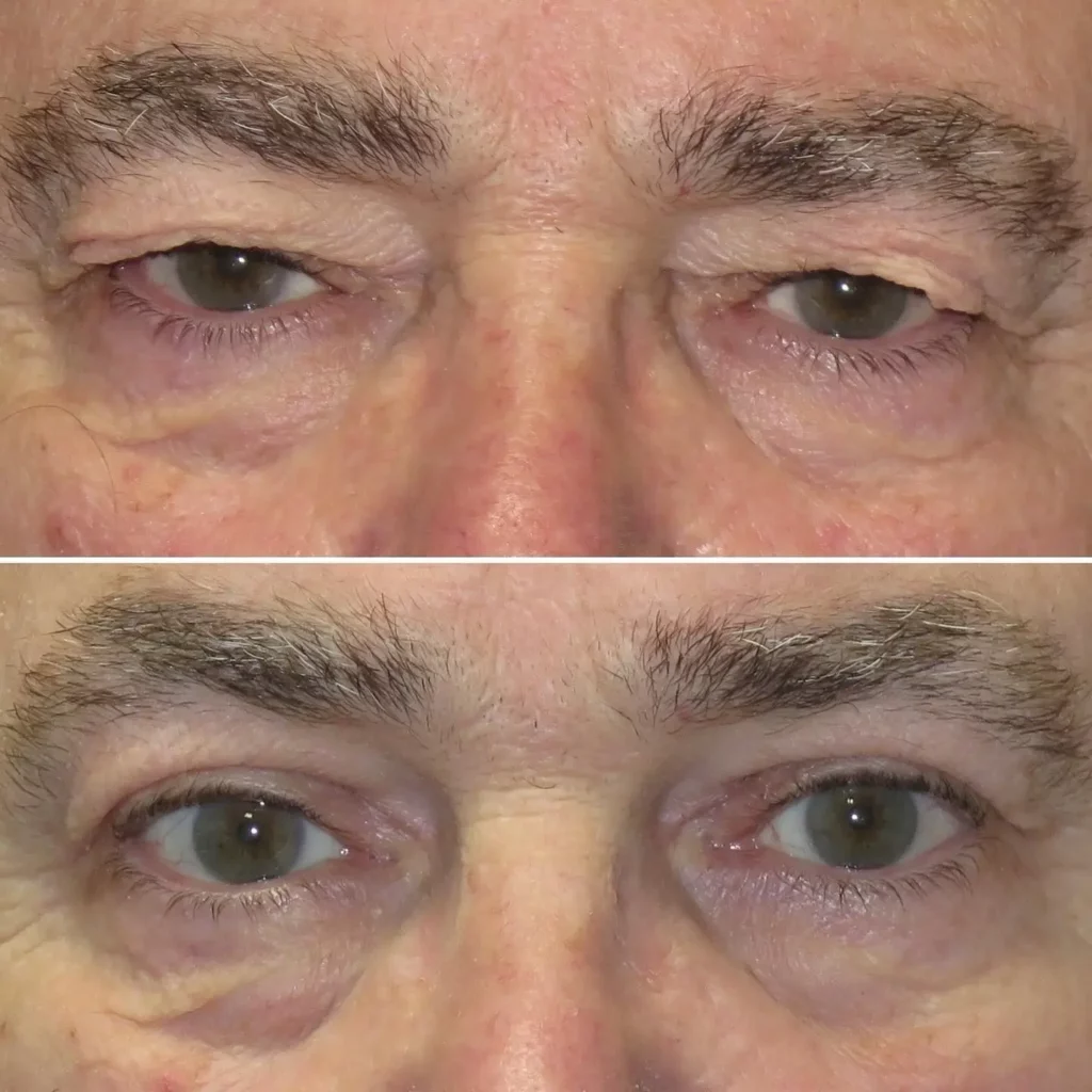 Blepharoplasty Before and After