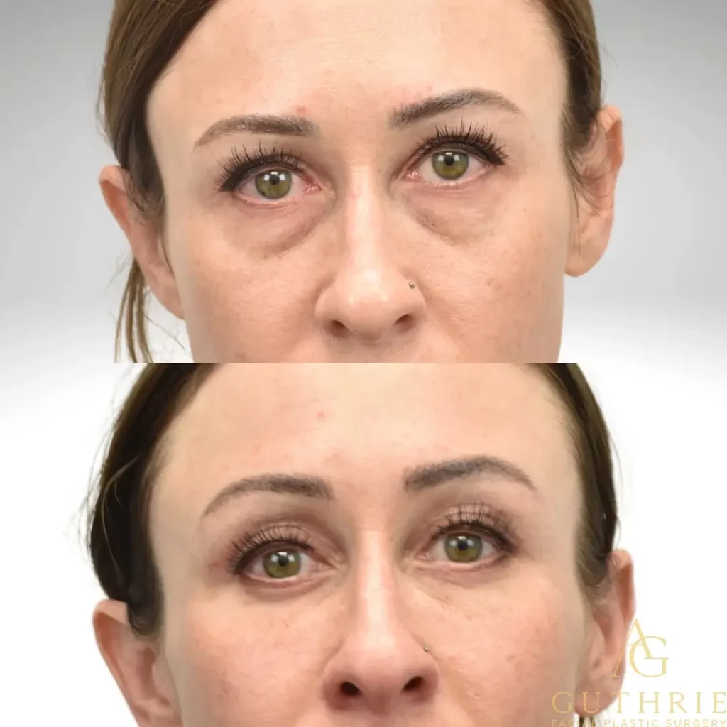 Blepharoplasty Before and After