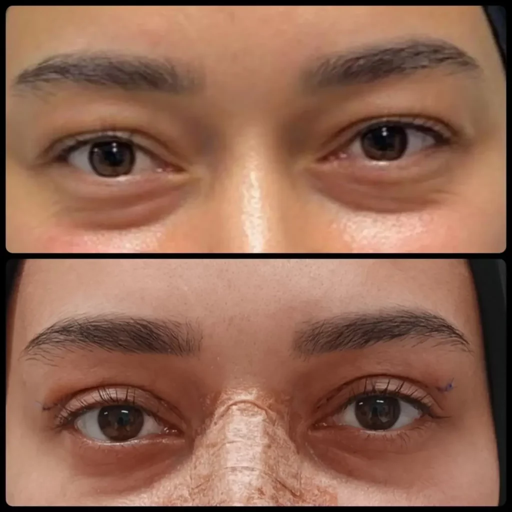 Blepharoplasty Before and After