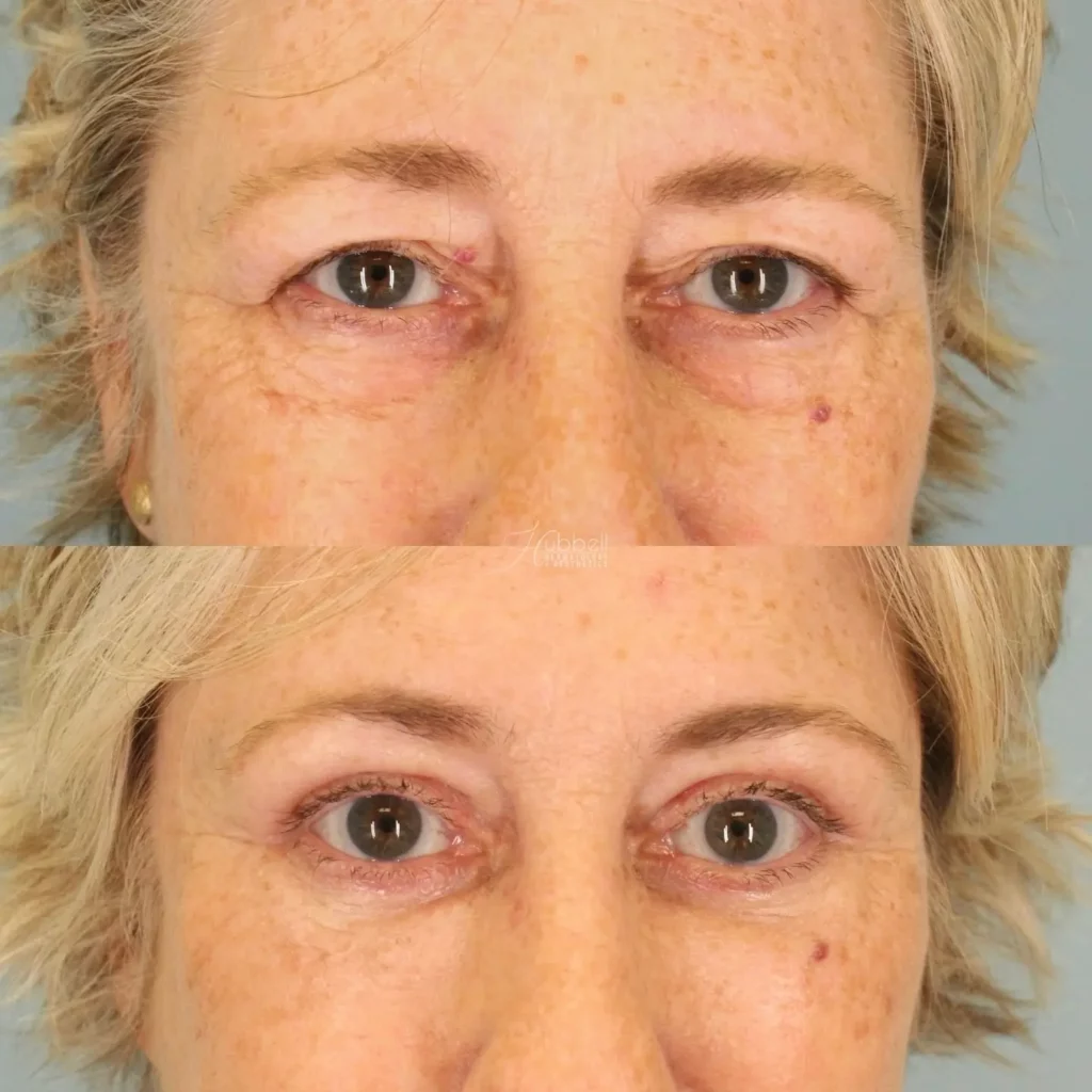 Blepharoplasty Before and After