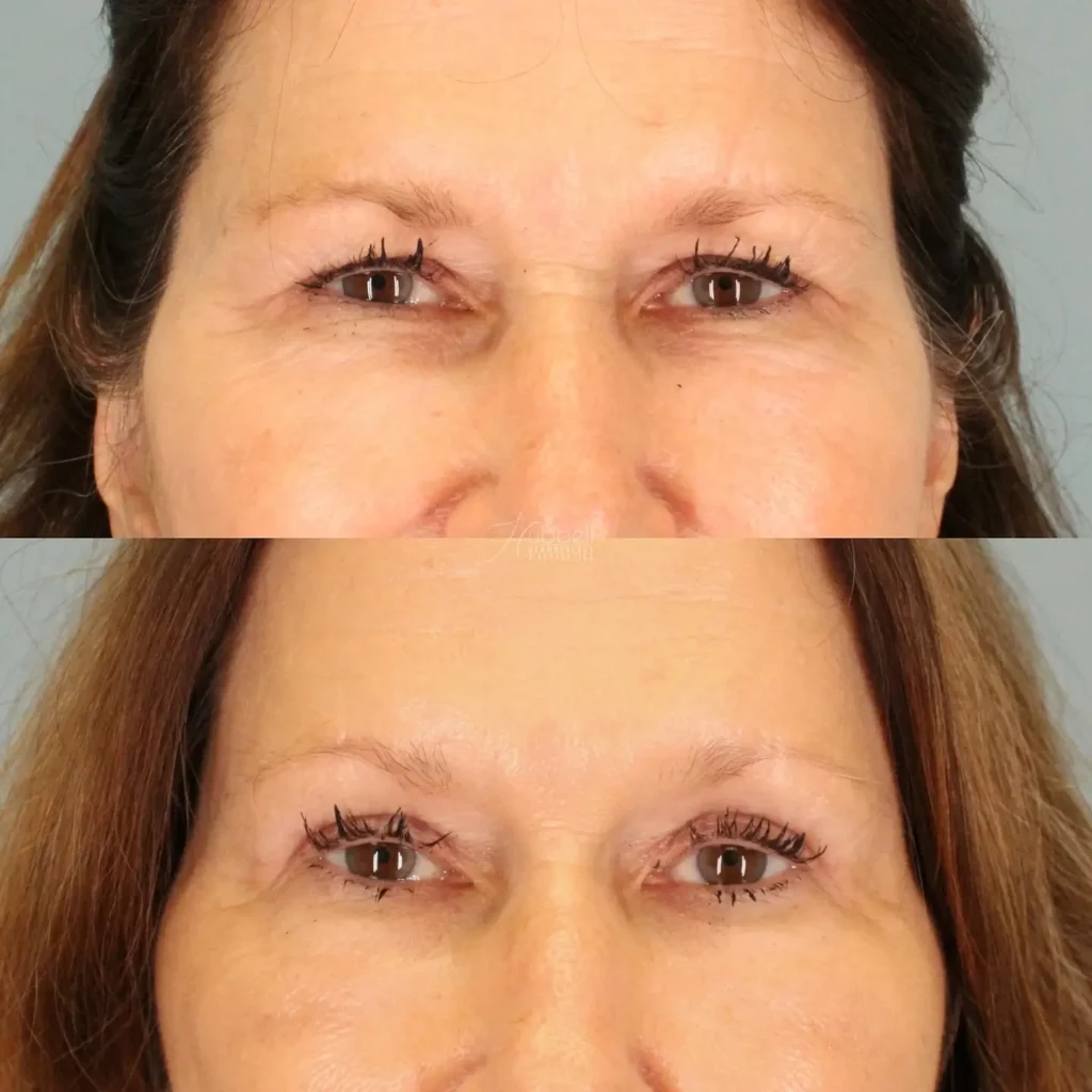 Blepharoplasty Before and After