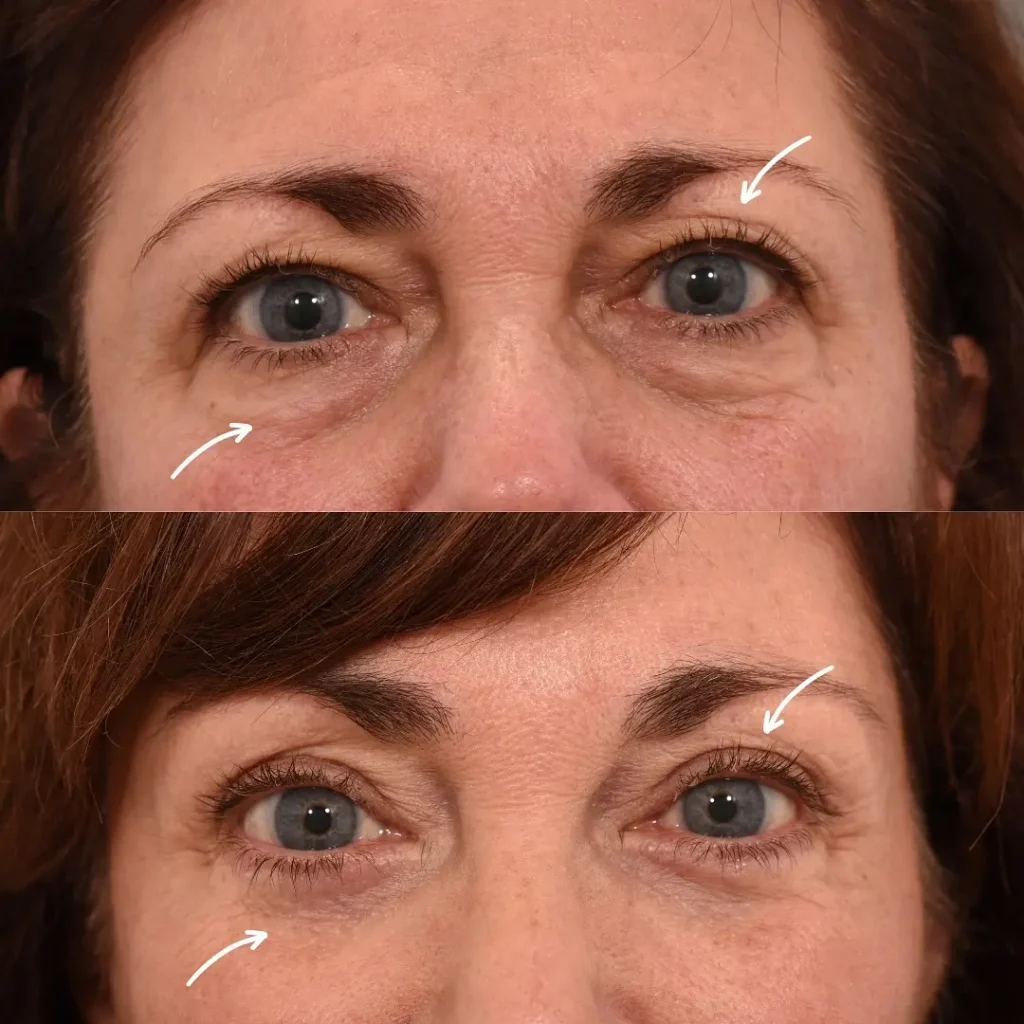 Blepharoplasty Before and After