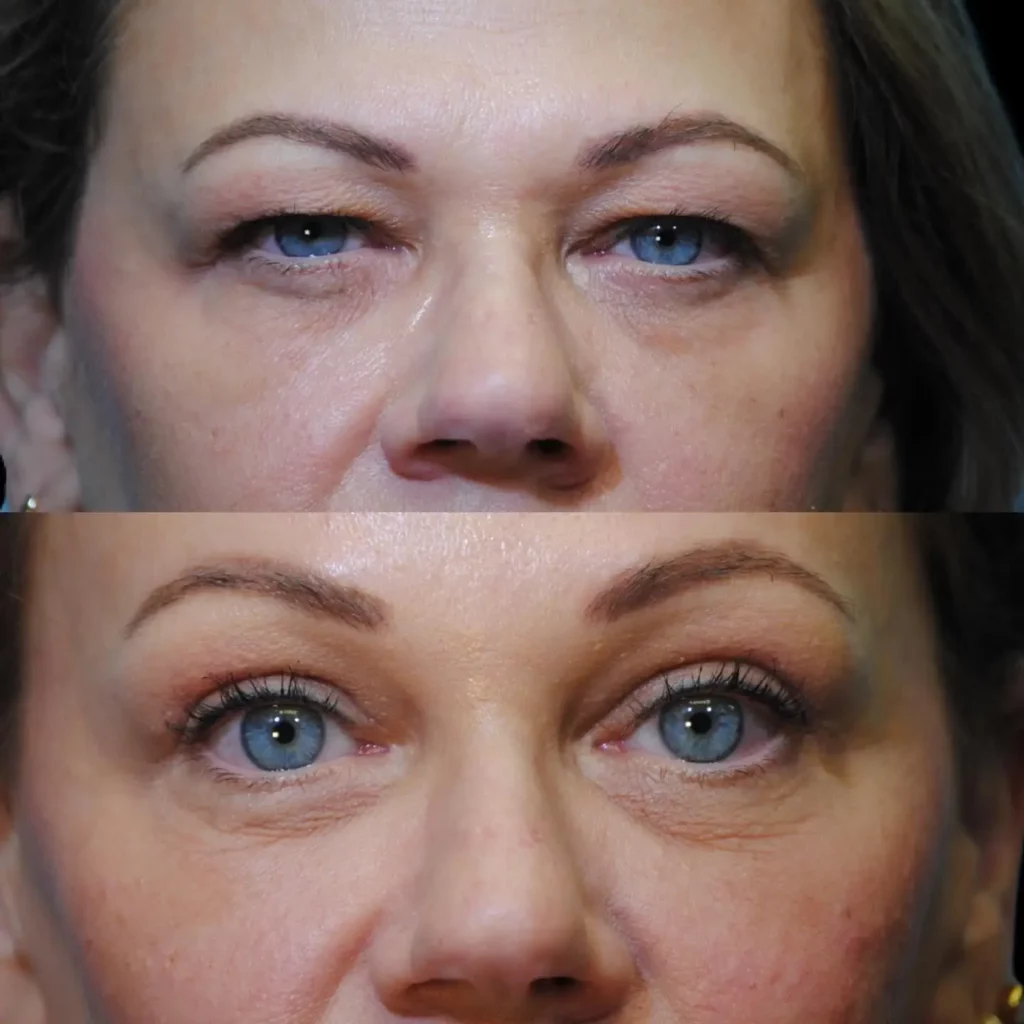 Blepharoplasty Before and After