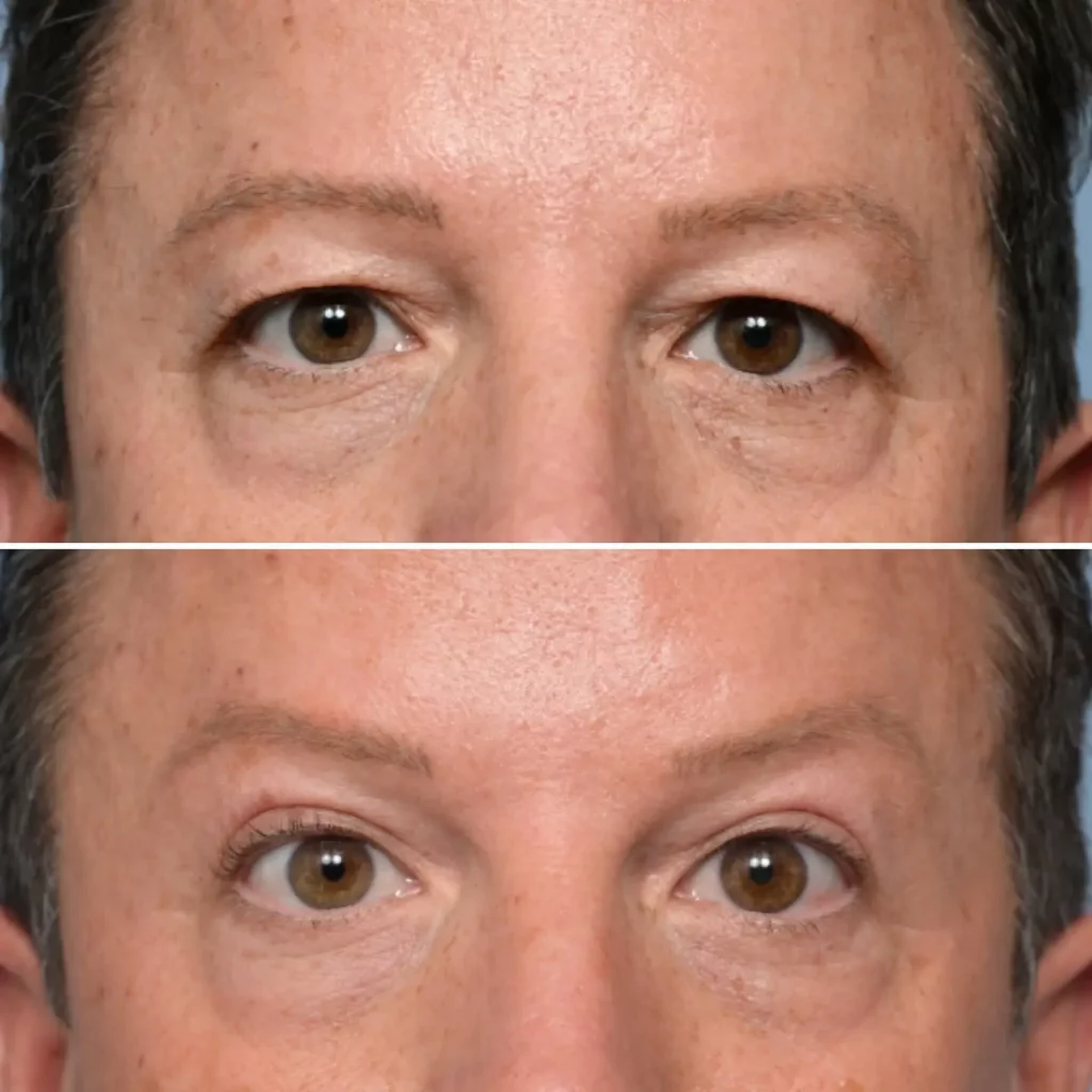 Blepharoplasty Before and After