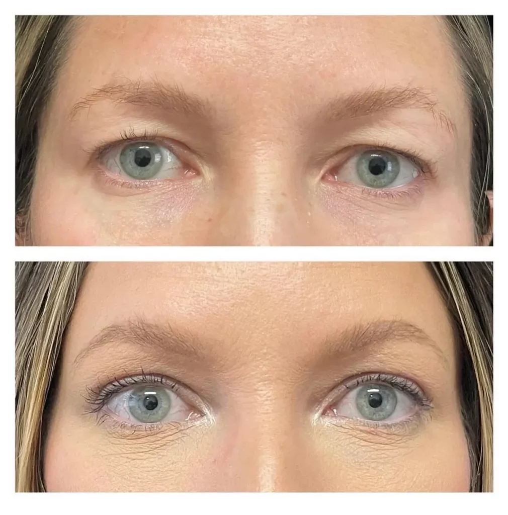 Blepharoplasty Before and After