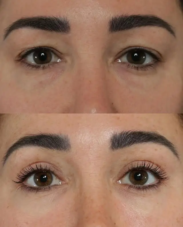 Blepharoplasty Before and After