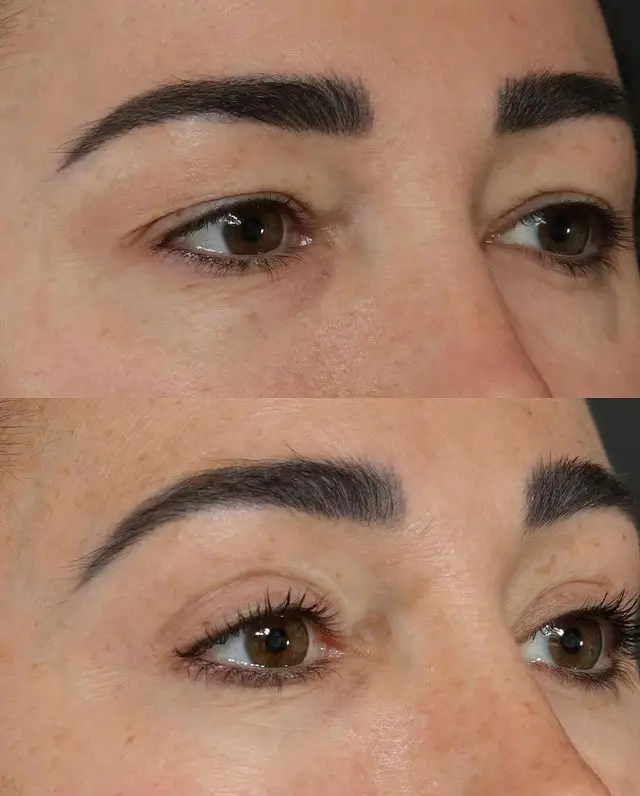 Blepharoplasty Before and After