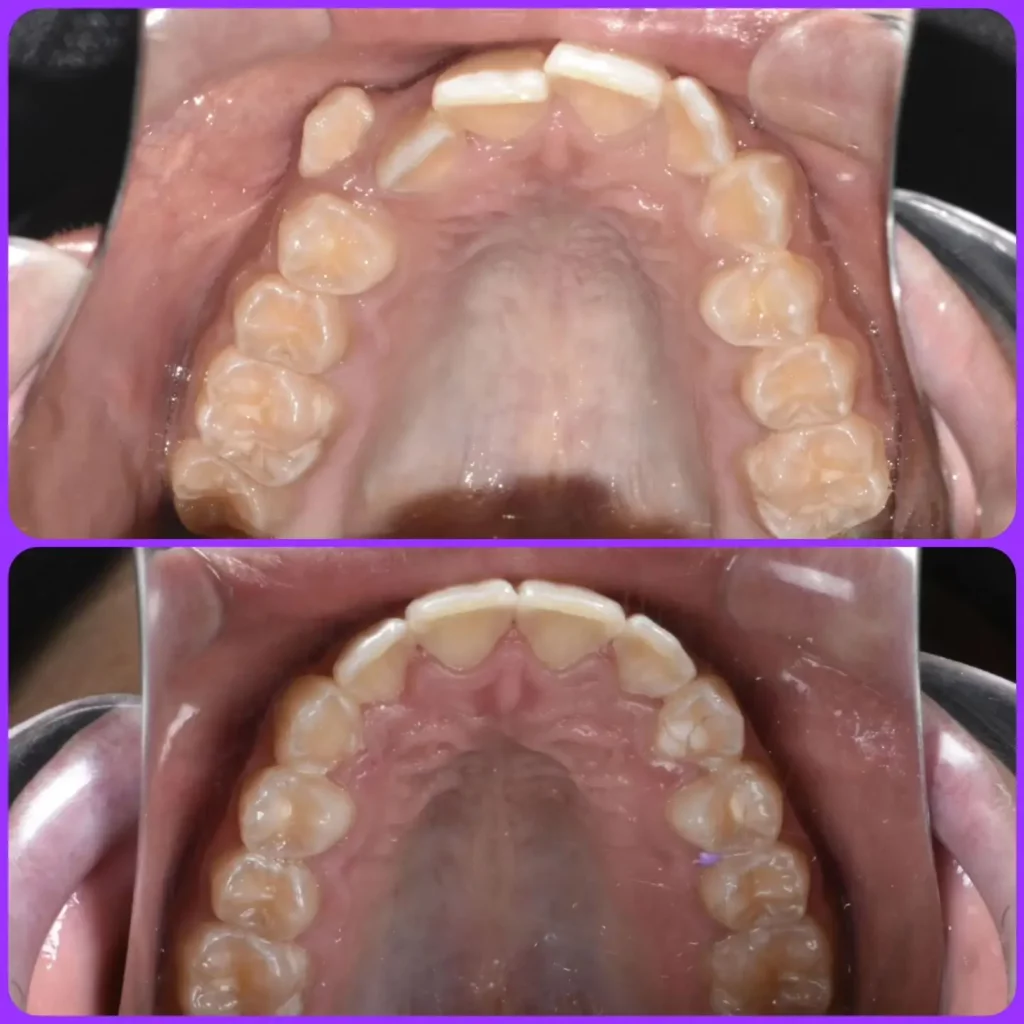 Braces Before and After