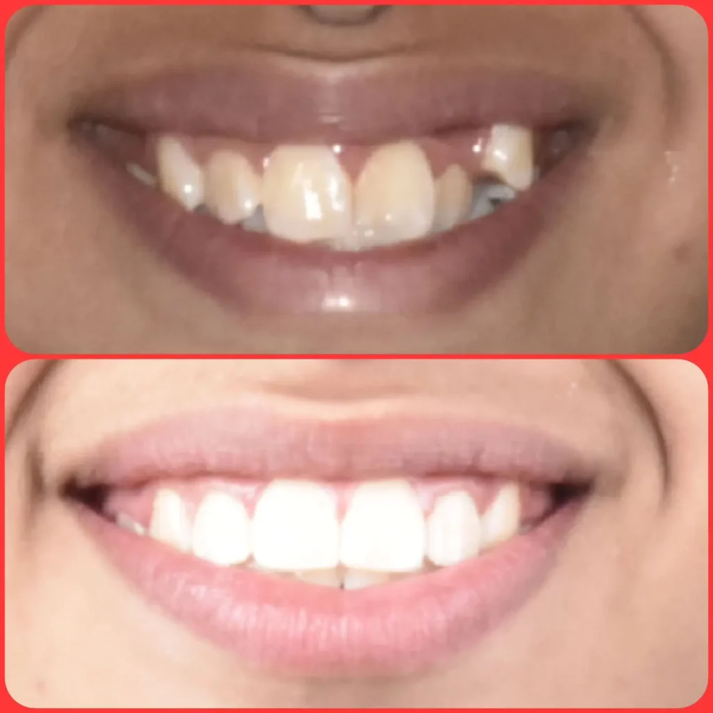 Braces Before and After