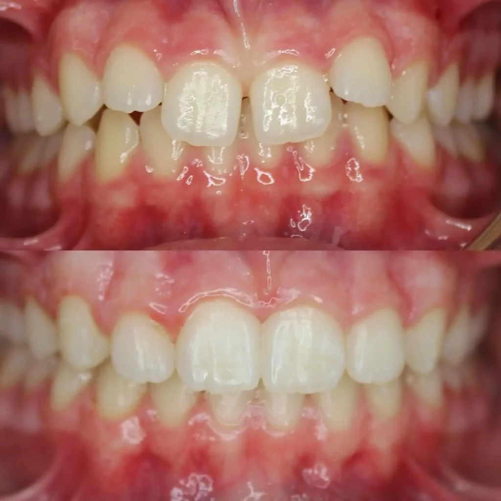 Braces Before and After