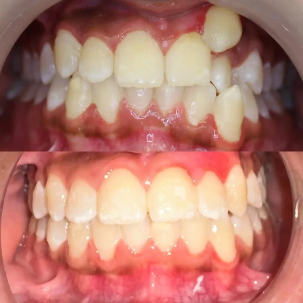 Braces Before and After