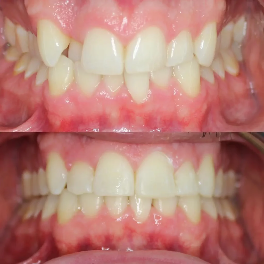 Braces Before and After