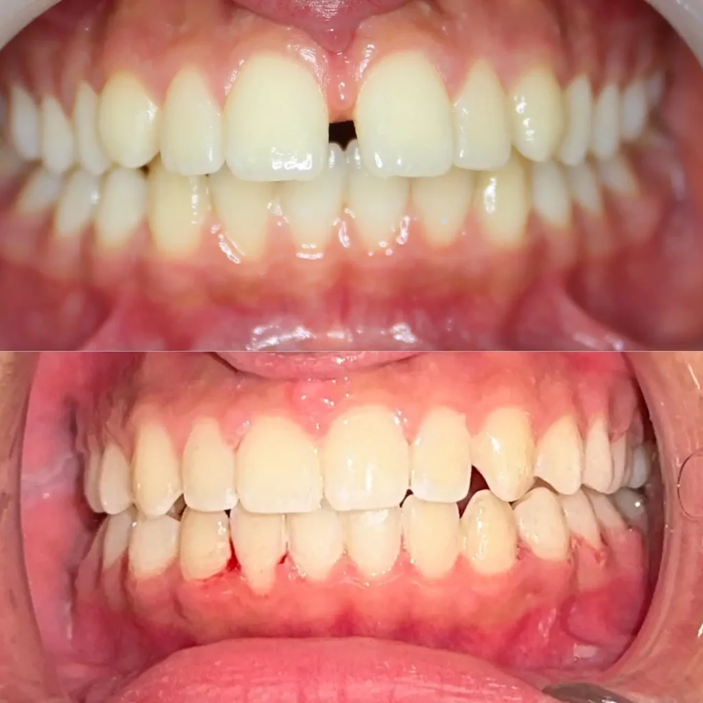 Braces Before and After