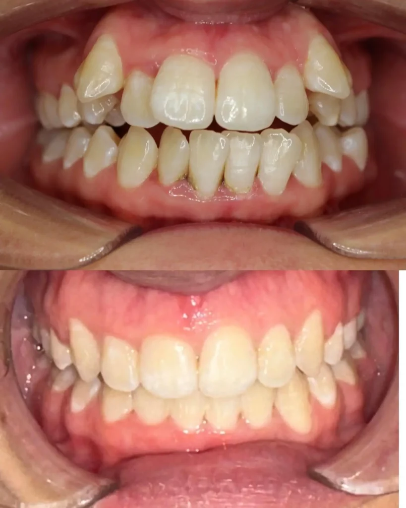 Braces Before and After