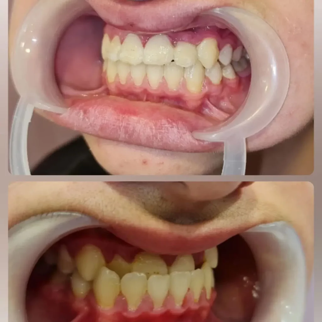 Braces Before and After