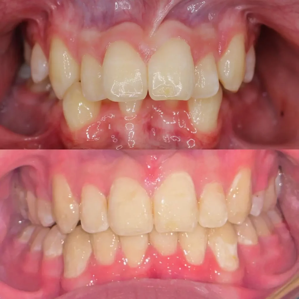 Braces Before and After