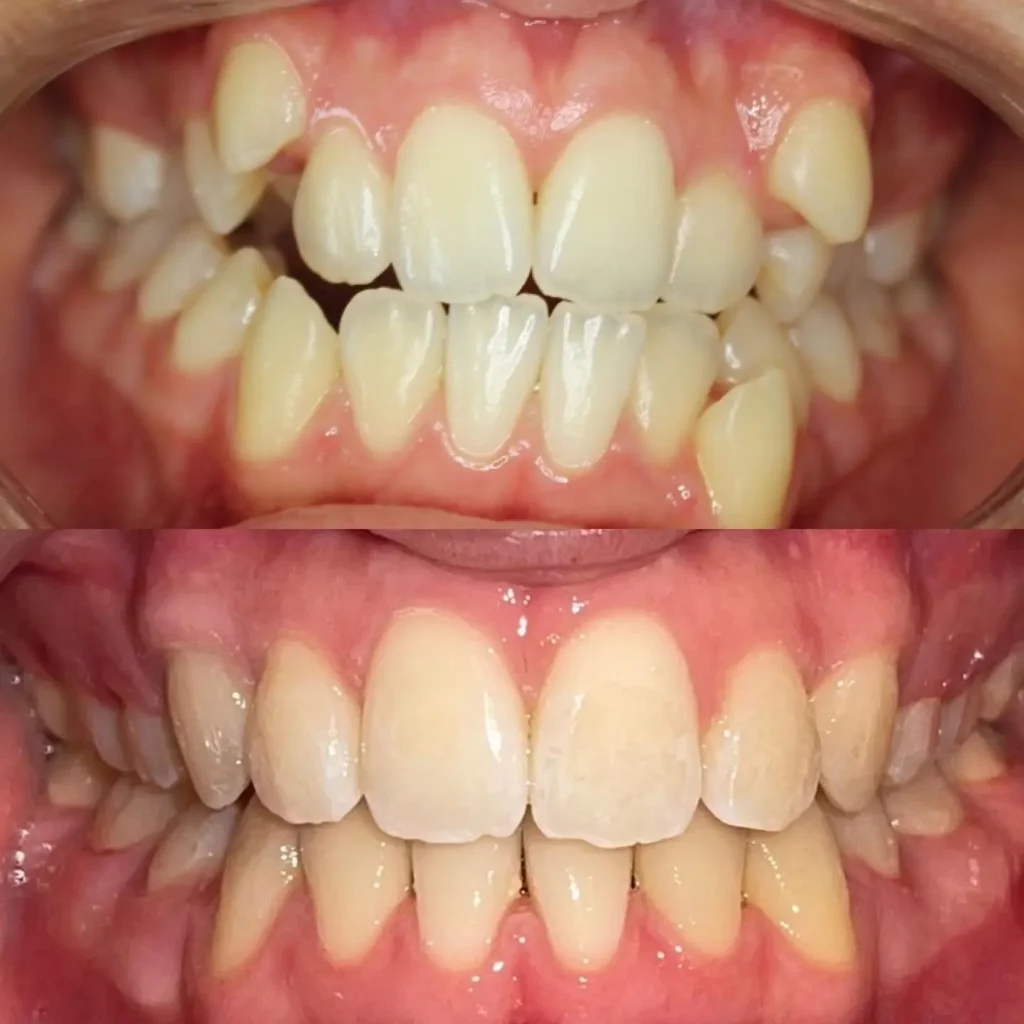 Braces Before and After