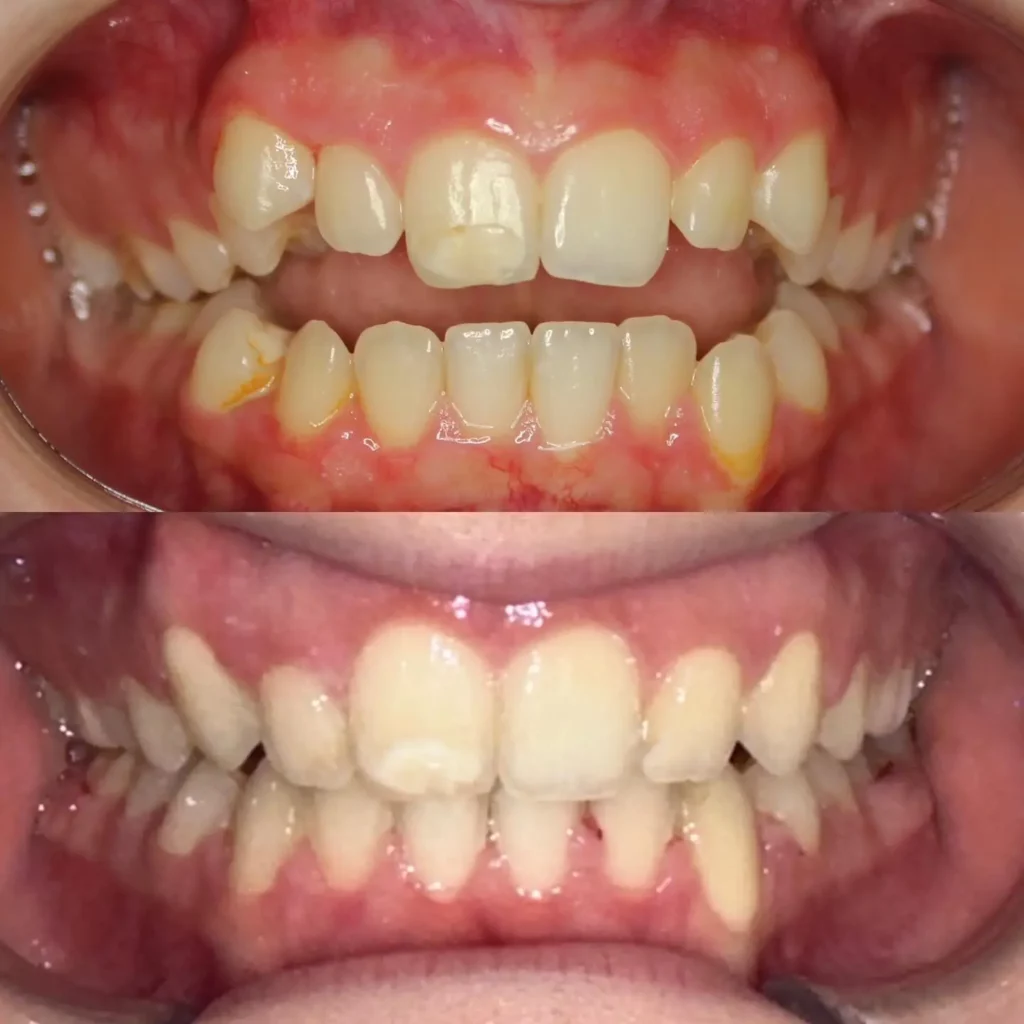 Braces Before and After