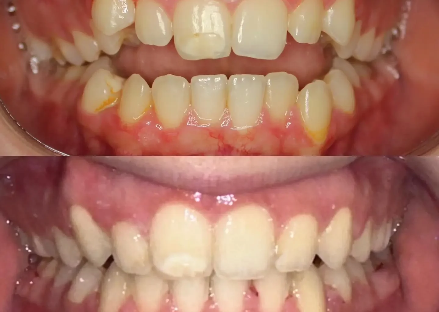 Braces Before and After