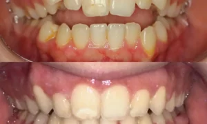 Braces Before and After