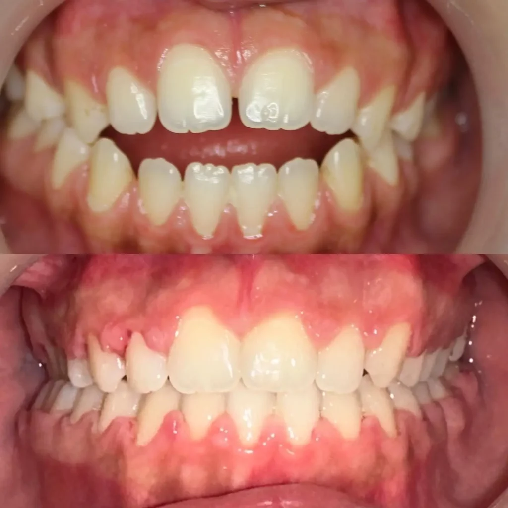 Braces Before and After