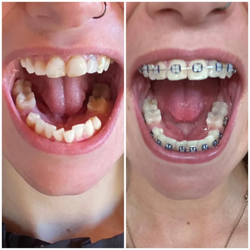 Braces Before and After