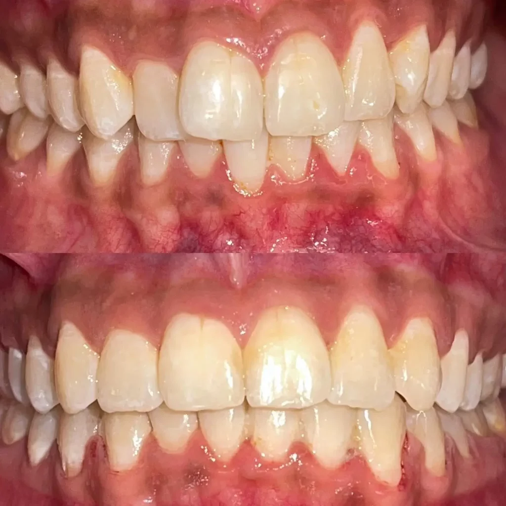 Braces Before and After