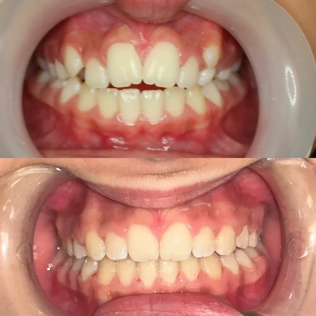 Braces Before and After