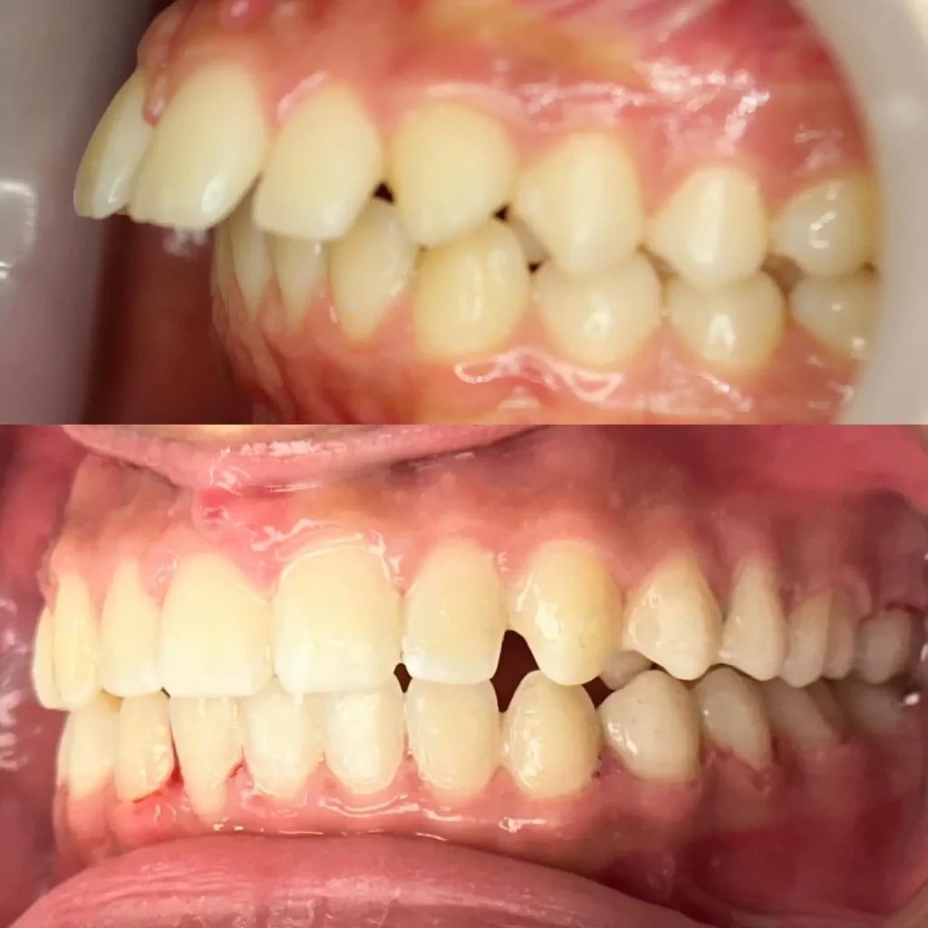 Braces Before and After