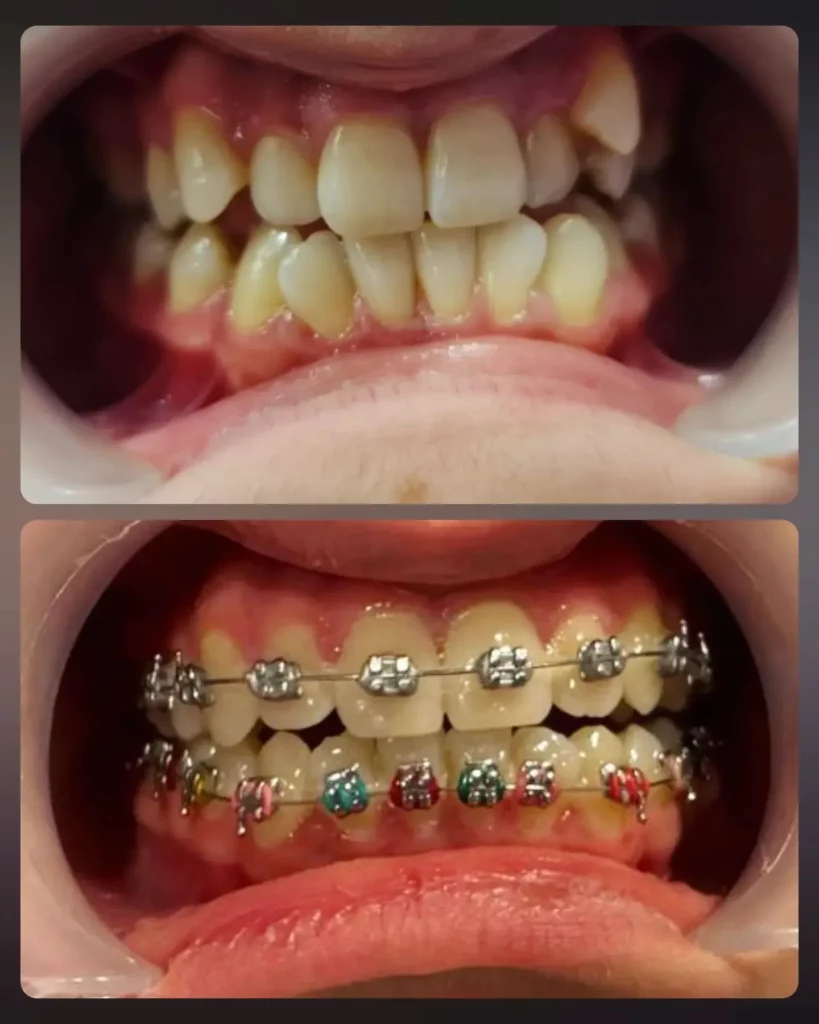 Braces Before and After