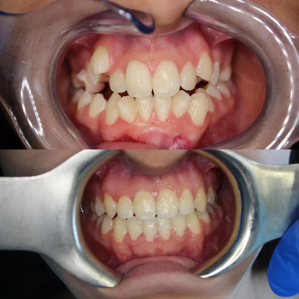 Braces Before and After