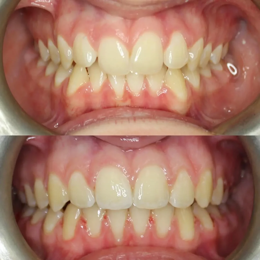 Braces Before and After