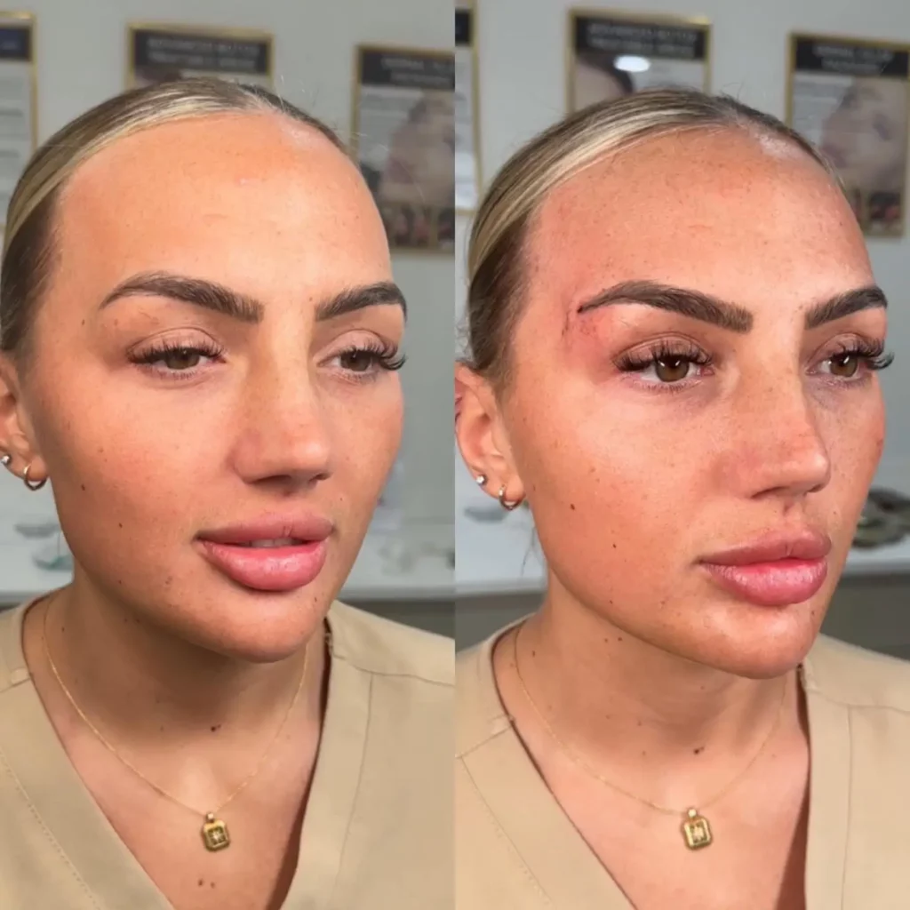 Brow Lift Before and After