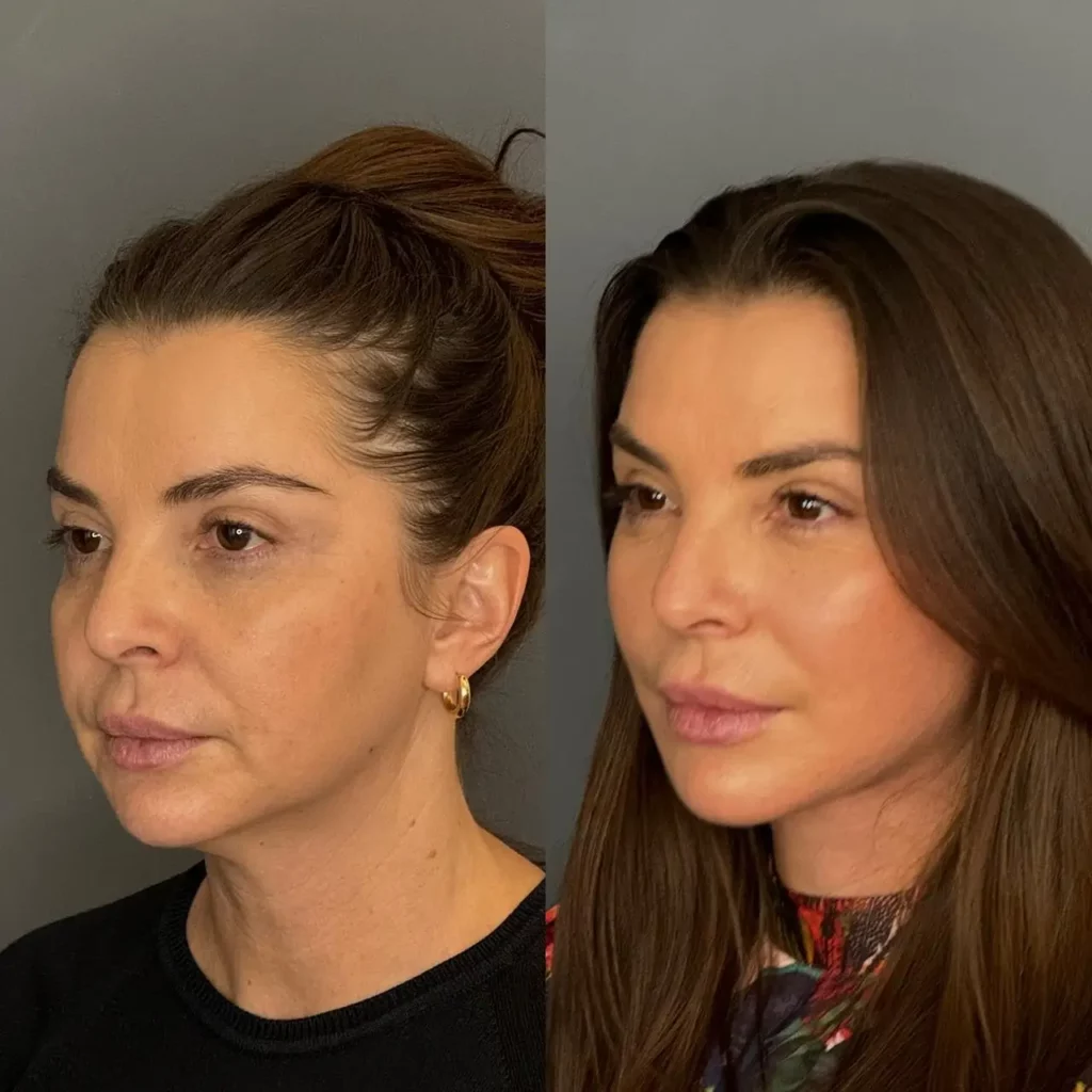 Brow Lift Before and After