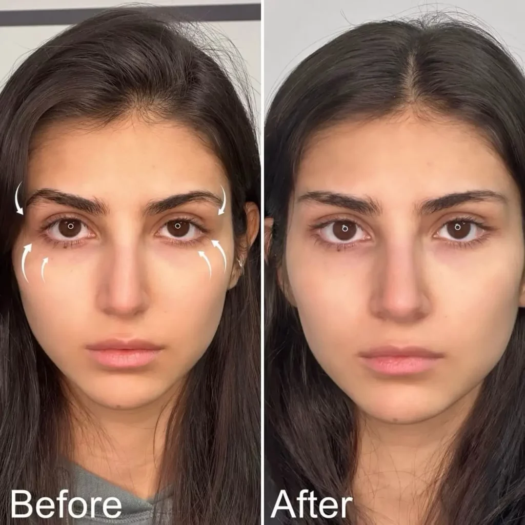 Brow Lift Before and After