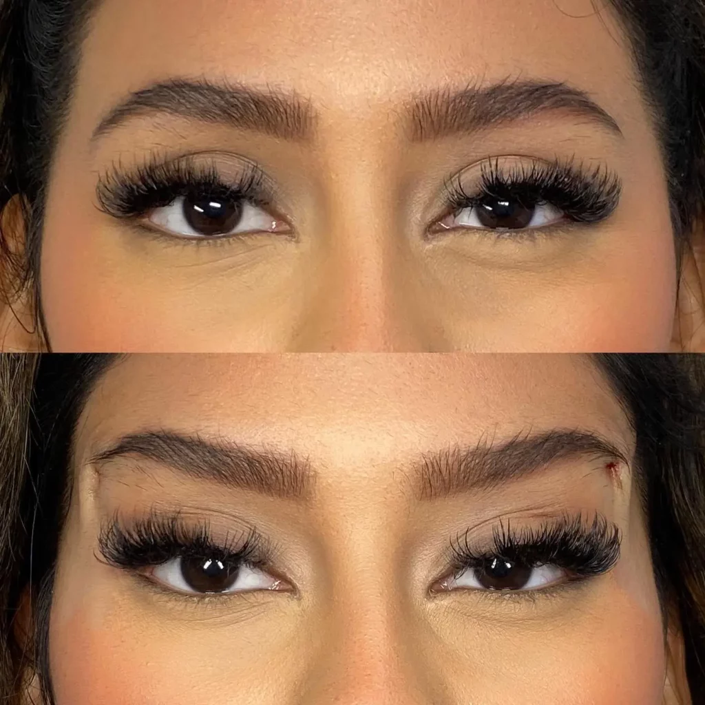 Brow Lift Before and After