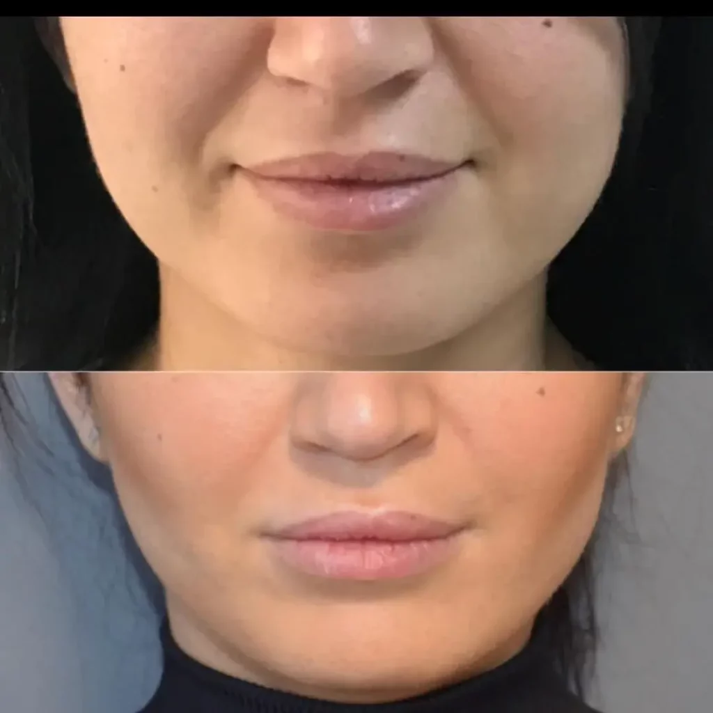 Buccal Fat Removal Before and After